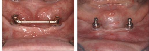 Tandheelkundige implantaten | Diakonessenhuis Diakonessenhuis