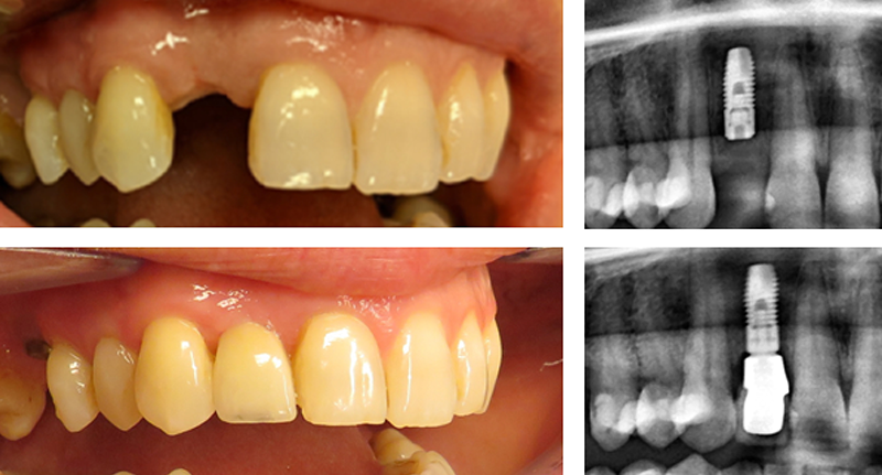 sneeuw effect majoor Tandheelkundige implantaten | Diakonessenhuis